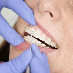 Clear Bracket / Ceramic Braces - Oral Health Center-Dental Care